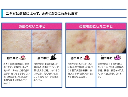 Kobayashi Medicated Acne Liquid 小林製藥神奇清痘筆12ml Mikoplace U K Premium Asian Product To U K