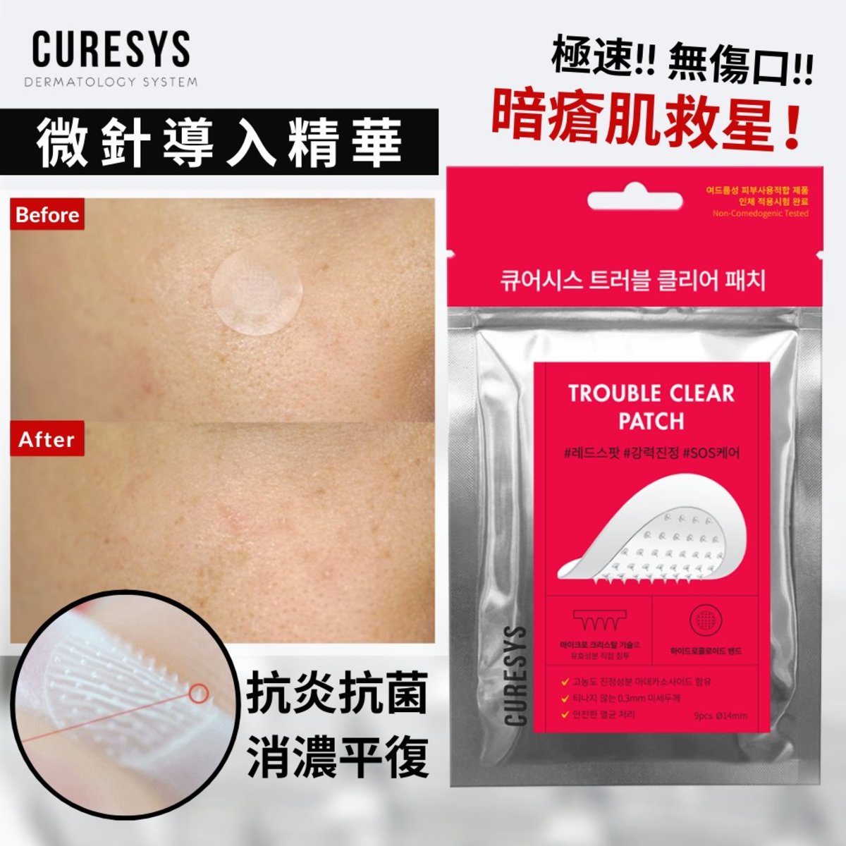 CURESYS | 微針修復淨痘貼 (9片裝) [紅色包裝] | HKTVmall 香港最大網購平台