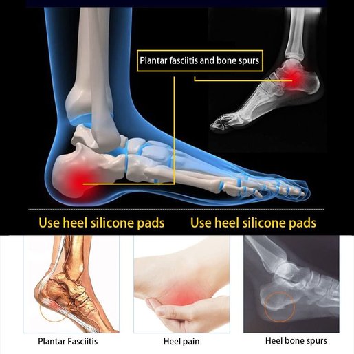 gel heel cups for plantar fasciitis